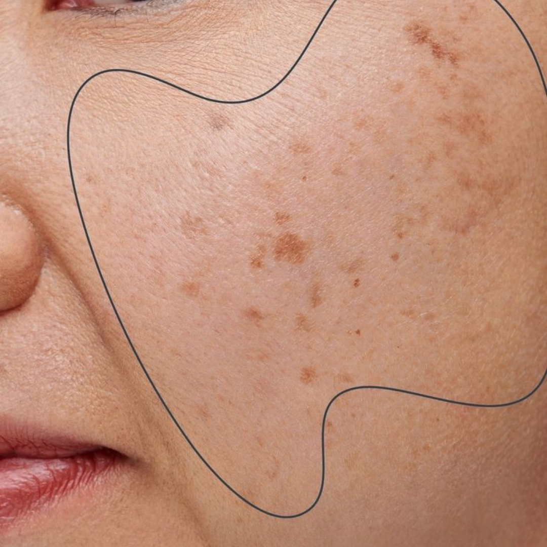Pigmentation & Dark Spots