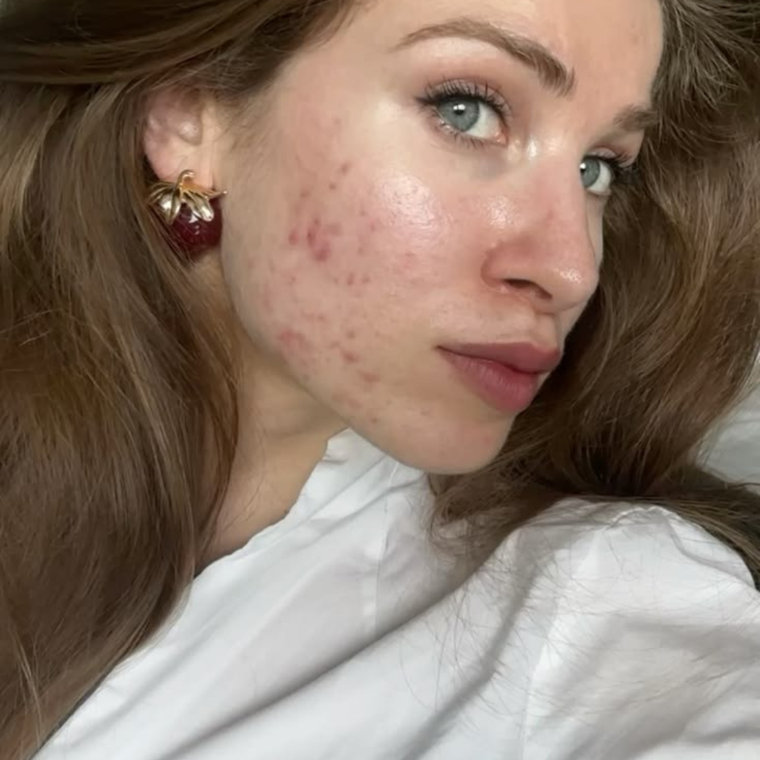 Acne & Blemishes